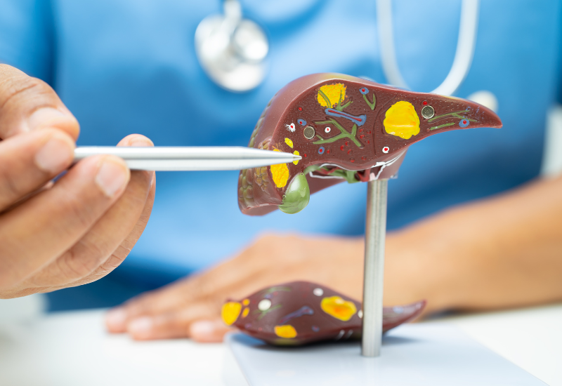 Gan nhiễm mỡ có nguy hiểm không? 5 dấu hiệu cần chú ý